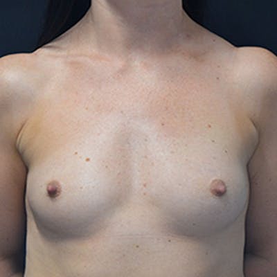 Breast Augmentation Before & After Gallery - Patient 114721056 - Image 1