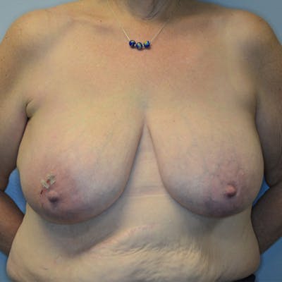 Breast Reduction Before & After Gallery - Patient 114721058 - Image 1