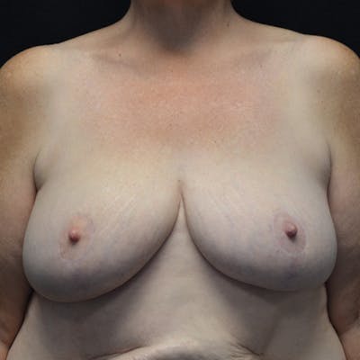 Breast Reduction Before & After Gallery - Patient 114721058 - Image 2