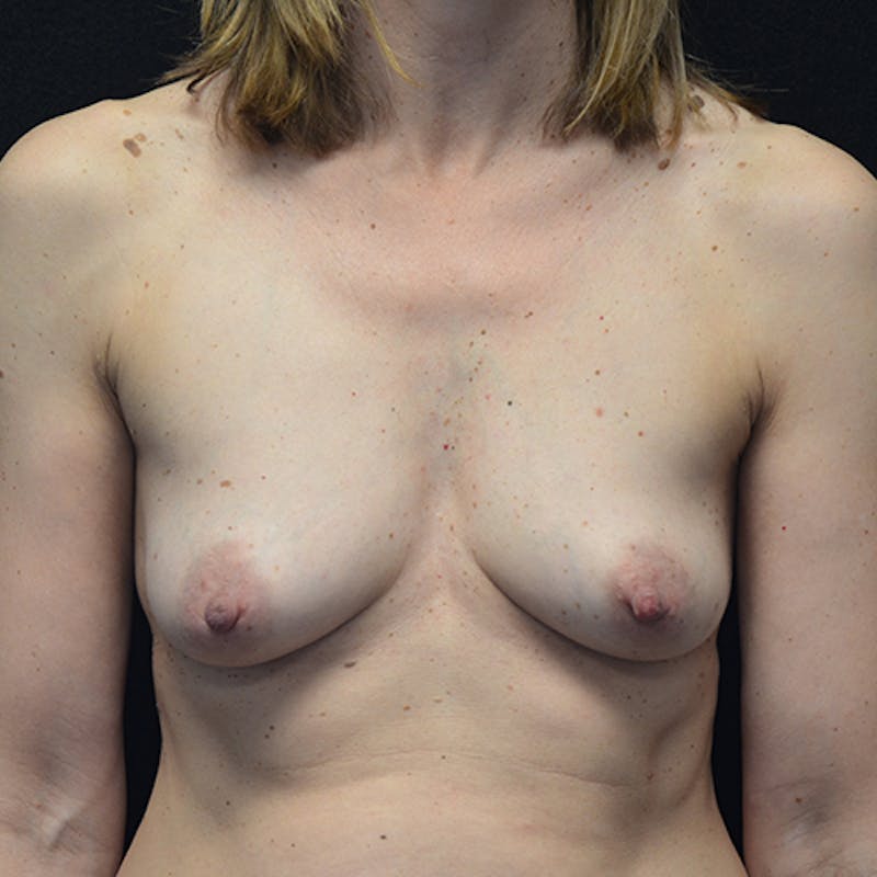 Breast Reconstruction Before & After Gallery - Patient 114721059 - Image 1