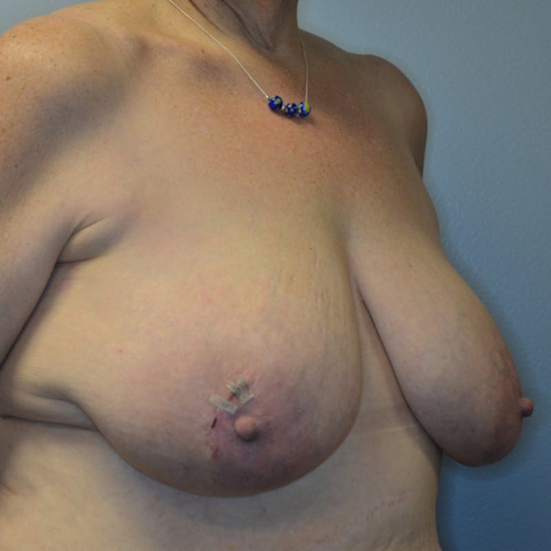 Breast Reduction Before & After Gallery - Patient 114721058 - Image 3