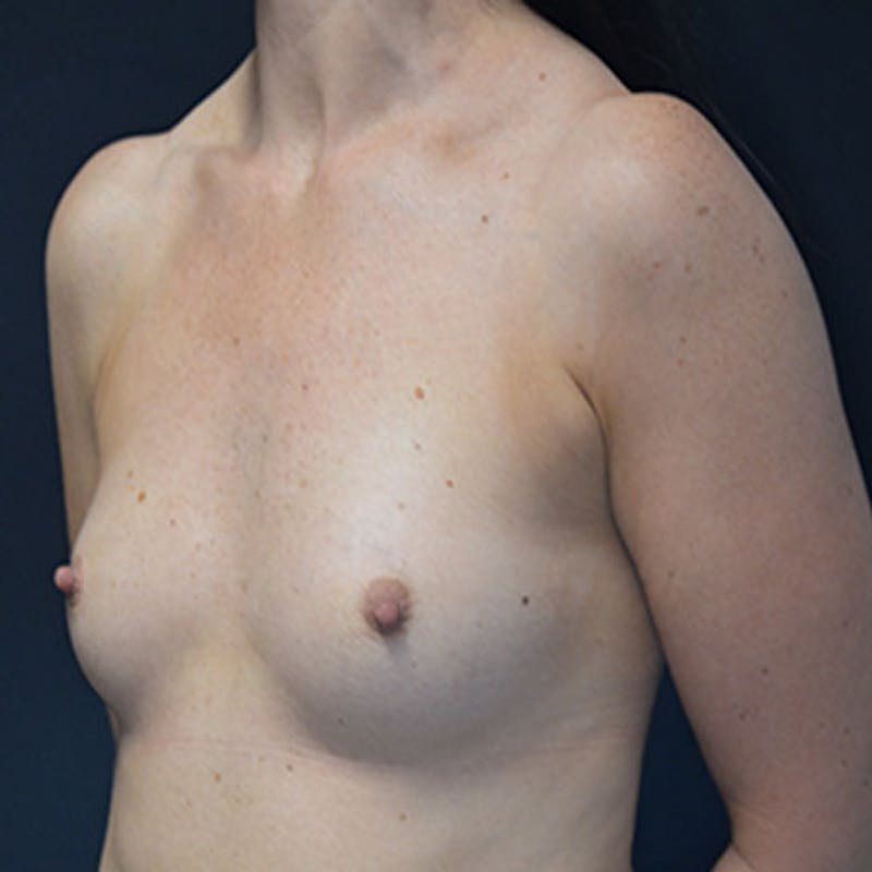 Breast Augmentation Before & After Gallery - Patient 114721056 - Image 7