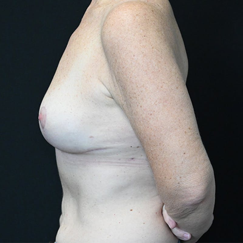 Breast Explant with Lift Before & After Gallery - Patient 114721055 - Image 10