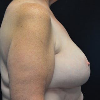 Breast Reduction Before & After Gallery - Patient 114721058 - Image 6
