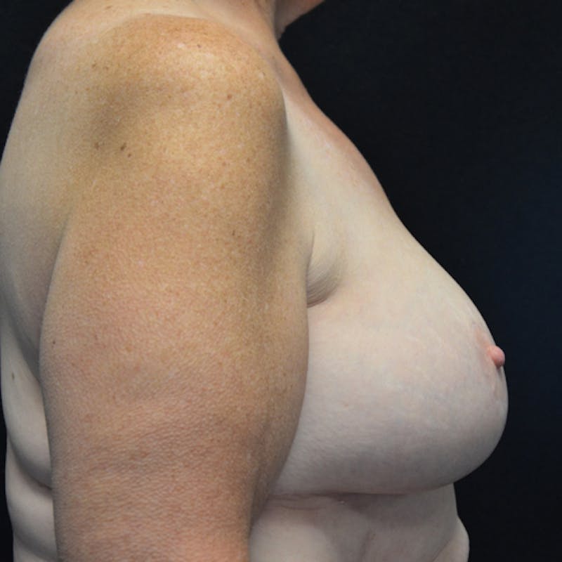 Breast Reduction Before & After Gallery - Patient 114721058 - Image 6