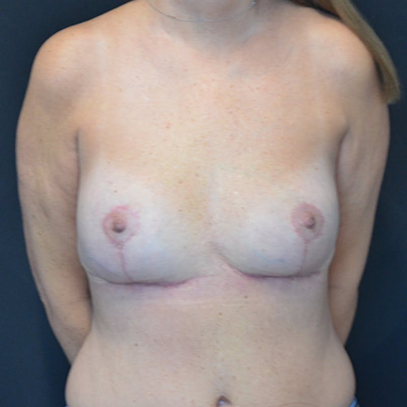 Breast Explant with Lift Before & After Gallery - Patient 114721060 - Image 2