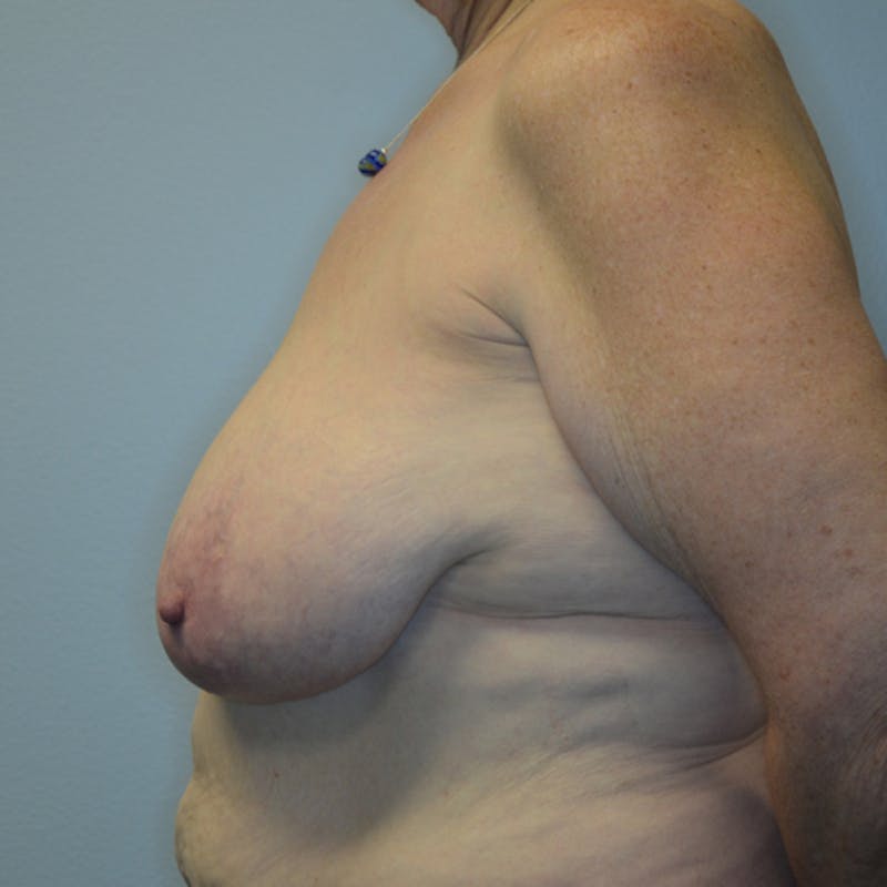 Breast Reduction Before & After Gallery - Patient 114721058 - Image 9