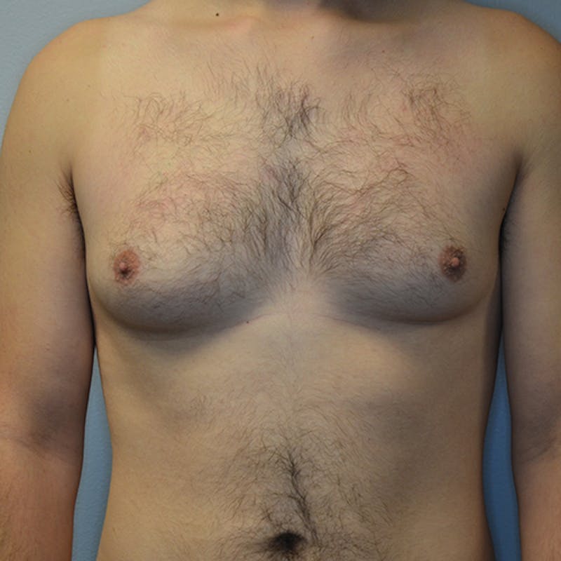 Gynecomastia Before & After Gallery - Patient 116789567 - Image 1