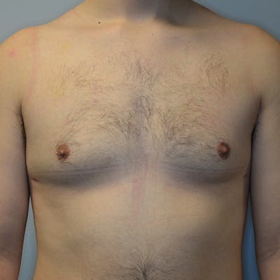Gynecomastia Before & After Gallery - Patient 114721062 - Image 2