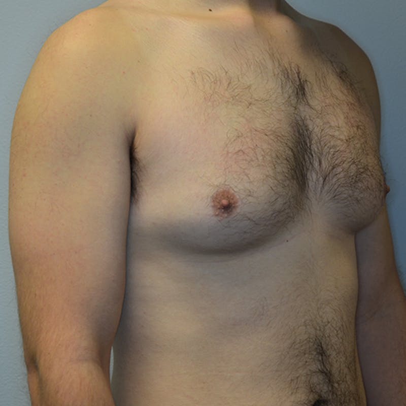 Gynecomastia Before & After Gallery - Patient 114721062 - Image 3