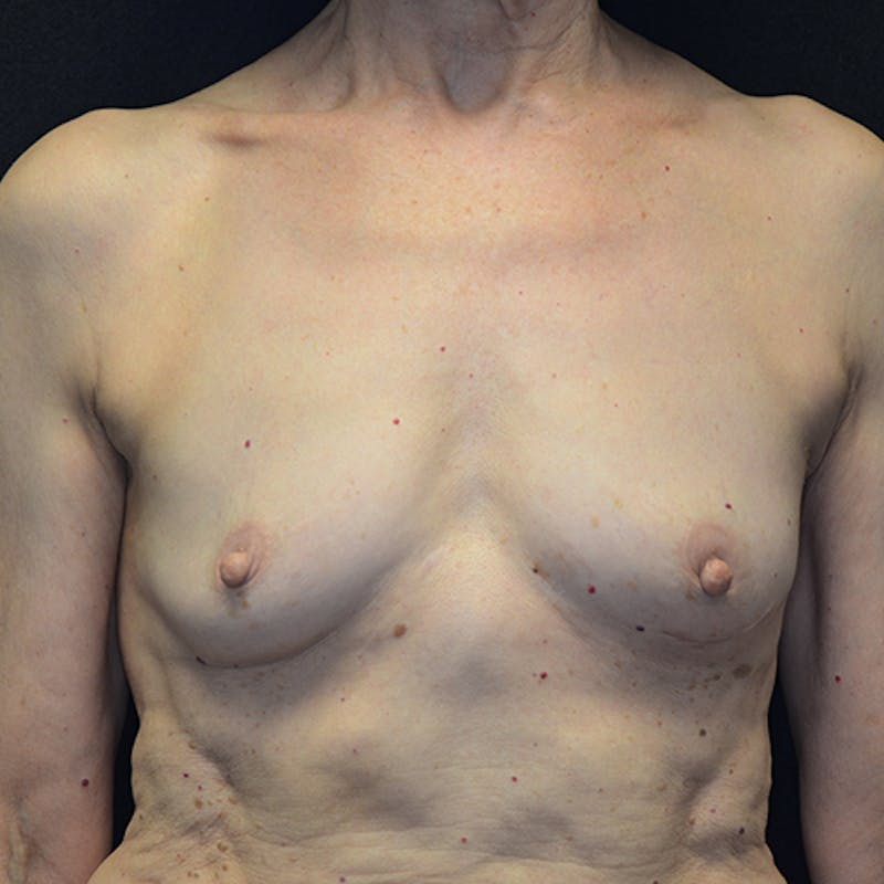 Breast Reconstruction Before & After Gallery - Patient 114721066 - Image 1