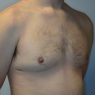 Gynecomastia Before & After Gallery - Patient 169244 - Image 4