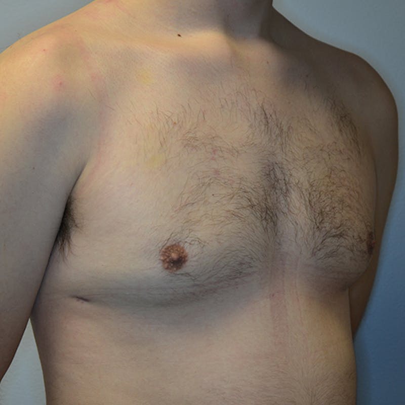 Gynecomastia Before & After Gallery - Patient 116789567 - Image 4