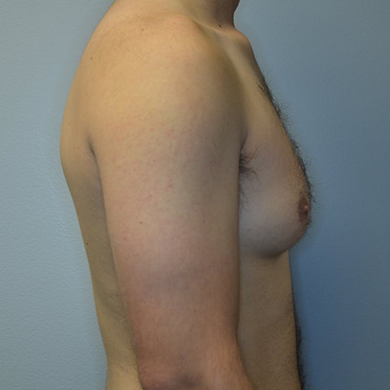 Gynecomastia Before & After Gallery - Patient 114721062 - Image 5