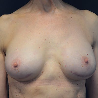Breast Reconstruction Before & After Gallery - Patient 114721066 - Image 2
