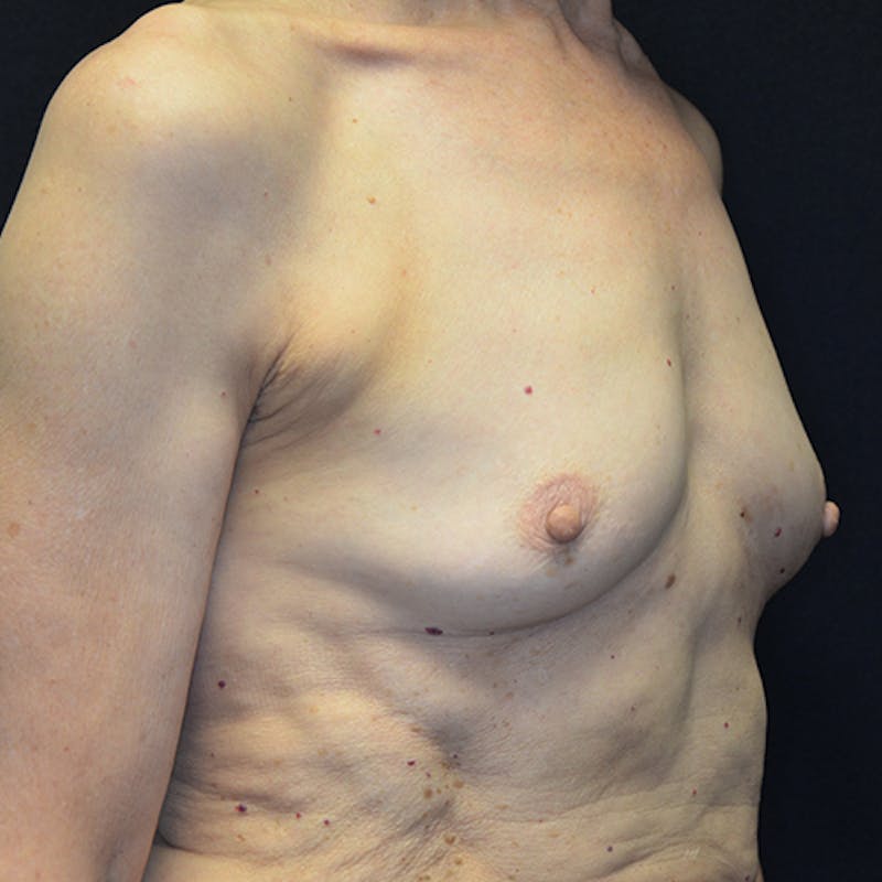 Breast Reconstruction Before & After Gallery - Patient 114721066 - Image 3