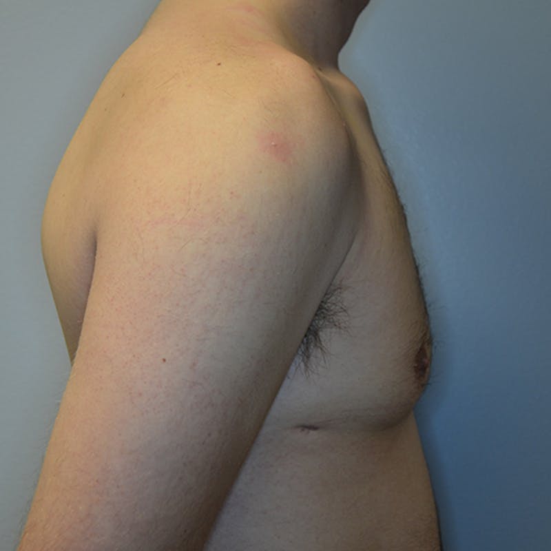 Gynecomastia Before & After Gallery - Patient 114721062 - Image 6