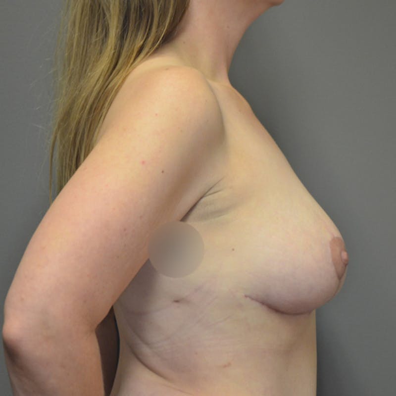 Breast Lift Before & After Gallery - Patient 114721063 - Image 6