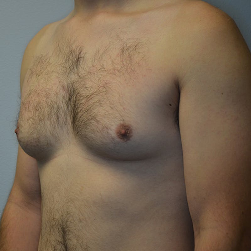 Gynecomastia Before & After Gallery - Patient 116789567 - Image 7