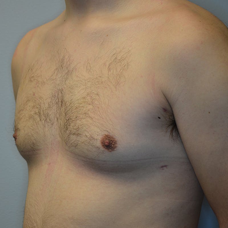 Gynecomastia Before & After Gallery - Patient 116789567 - Image 8