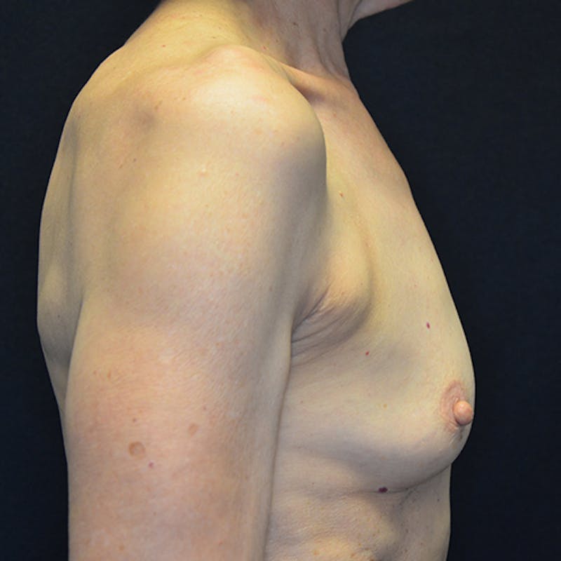 Breast Reconstruction Before & After Gallery - Patient 114721066 - Image 5
