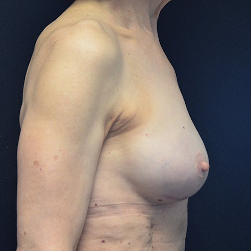 Breast Reconstruction Before & After Gallery - Patient 114721066 - Image 6