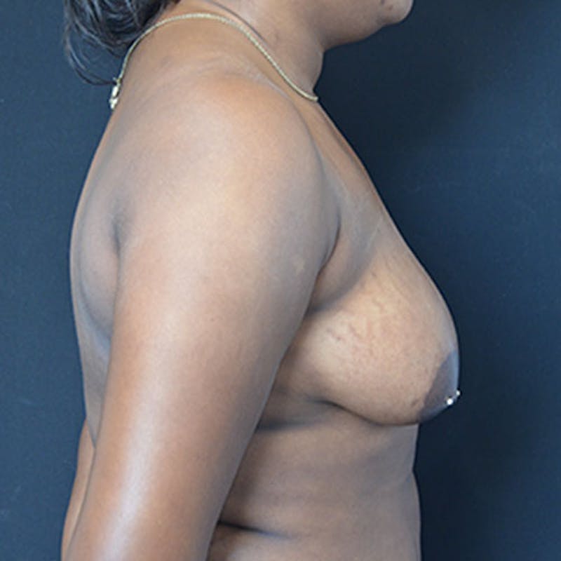 Breast Augmentation Before & After Gallery - Patient 114721065 - Image 5