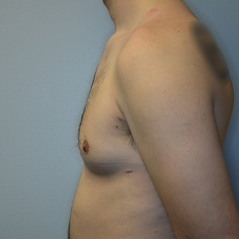Gynecomastia Before & After Gallery - Patient 169244 - Image 10