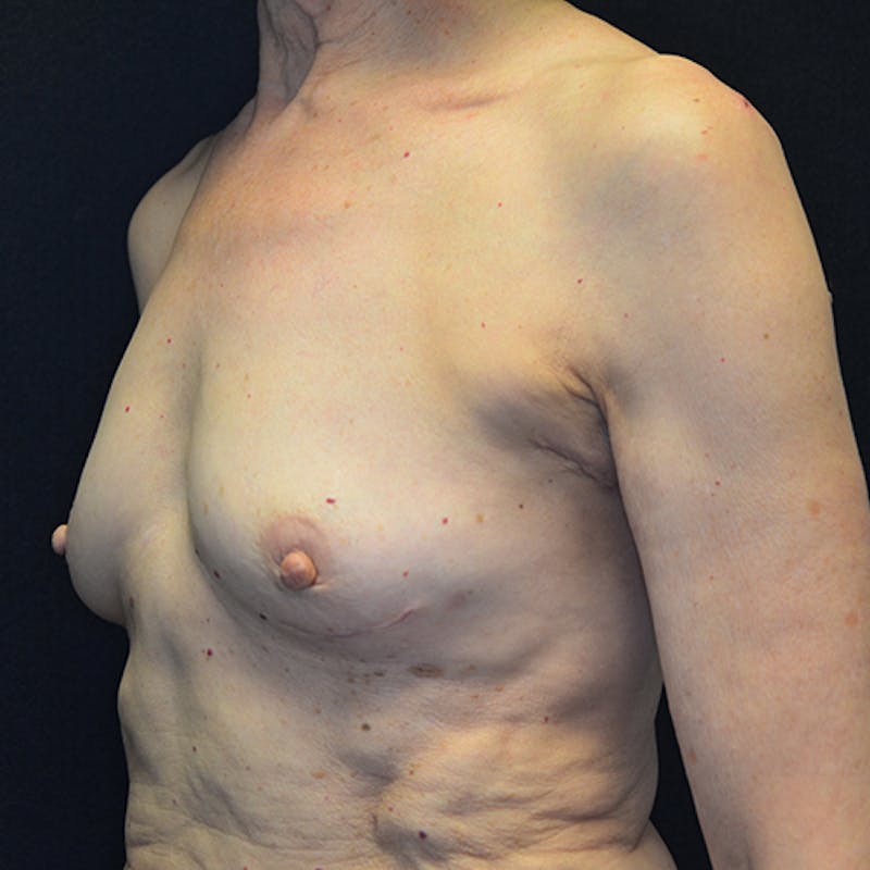 Breast Reconstruction Before & After Gallery - Patient 114721066 - Image 7