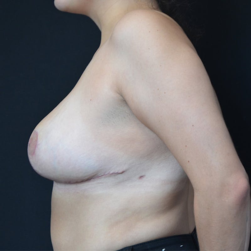 Breast Reduction Before & After Gallery - Patient 114721064 - Image 10