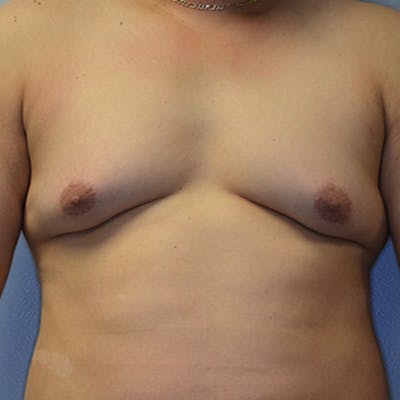 Gynecomastia Before & After Gallery - Patient 114721070 - Image 1