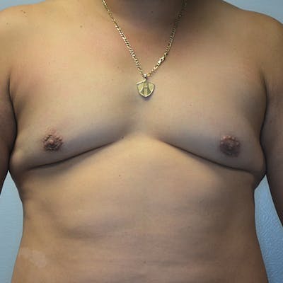 Gynecomastia Before & After Gallery - Patient 114721070 - Image 2