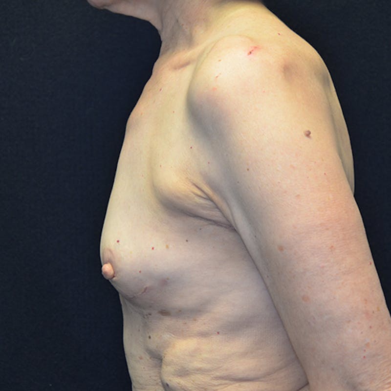 Breast Reconstruction Before & After Gallery - Patient 114721066 - Image 9