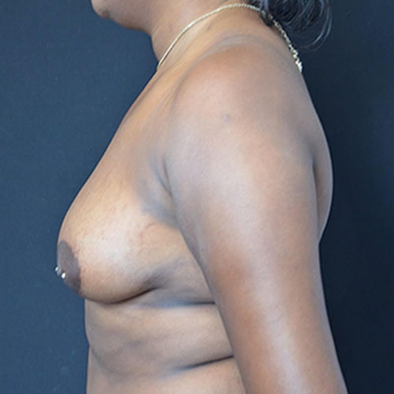 Breast Augmentation Before & After Gallery - Patient 114721065 - Image 9