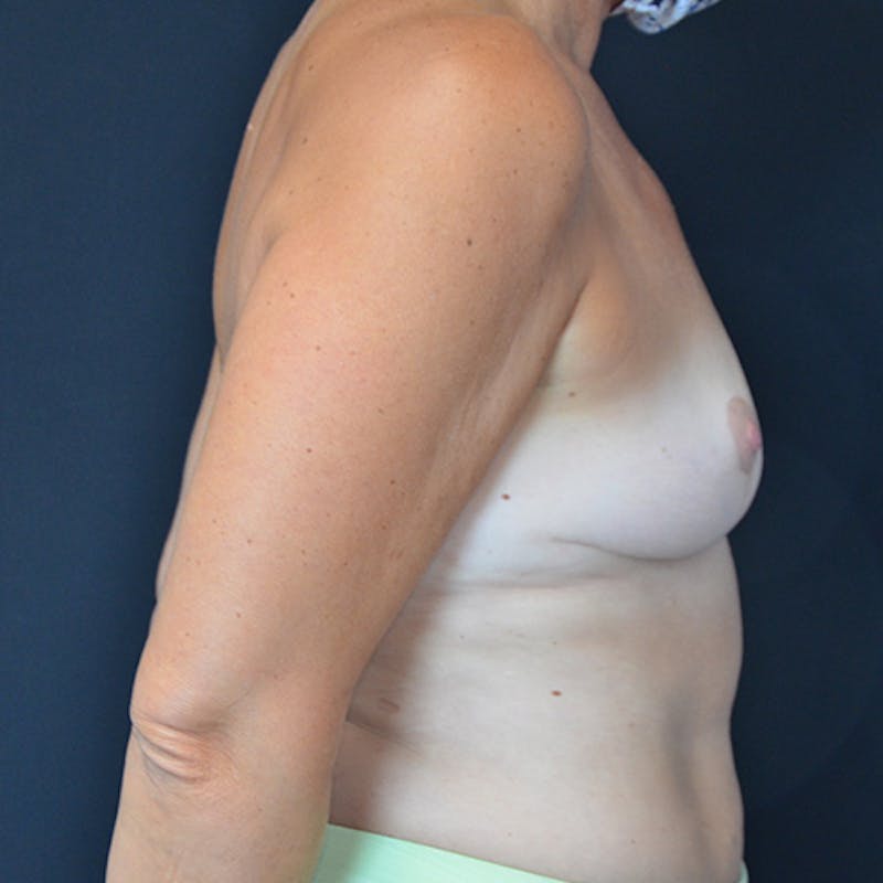 Breast Explant with Lift Before & After Gallery - Patient 114721067 - Image 8