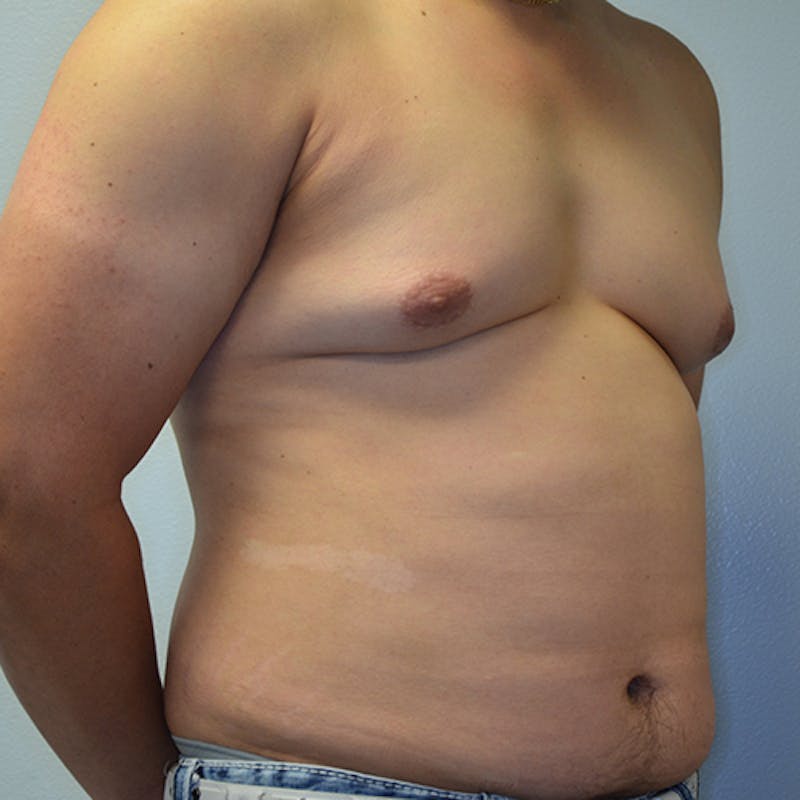 Gynecomastia Before & After Gallery - Patient 114721070 - Image 3