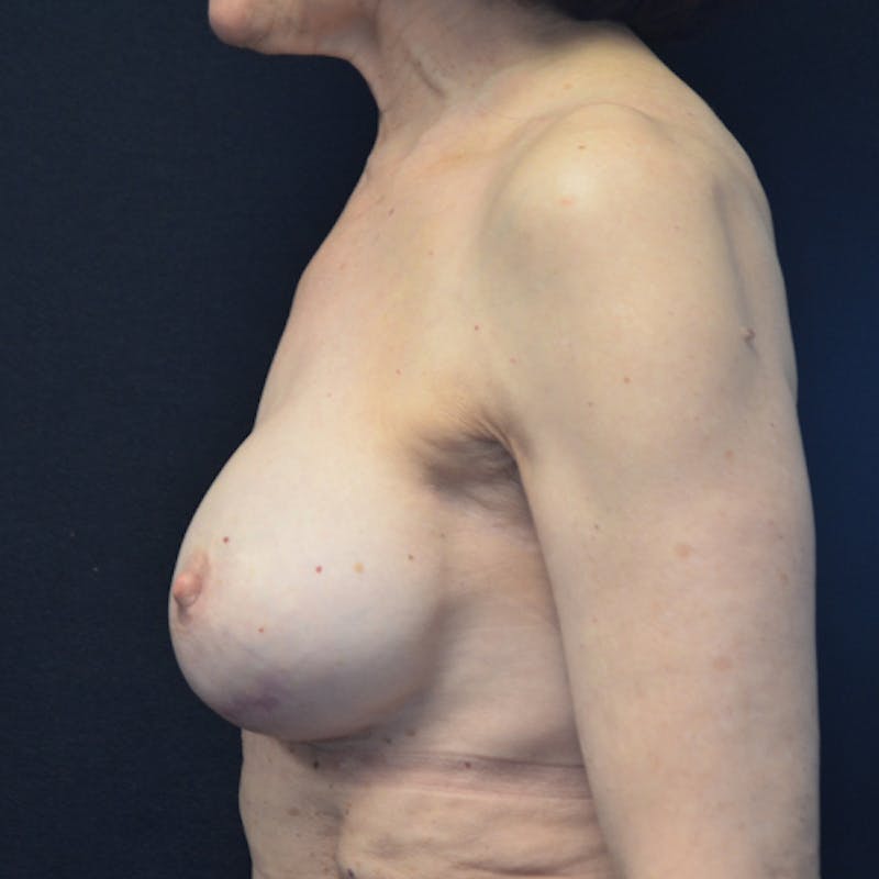 Breast Reconstruction Before & After Gallery - Patient 114721066 - Image 10