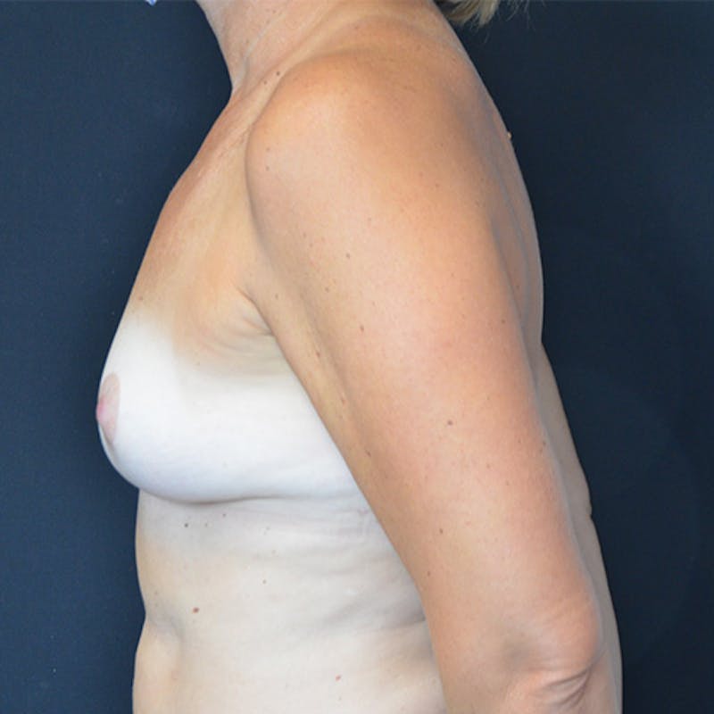 Breast Explant with Lift Before & After Gallery - Patient 114721067 - Image 10