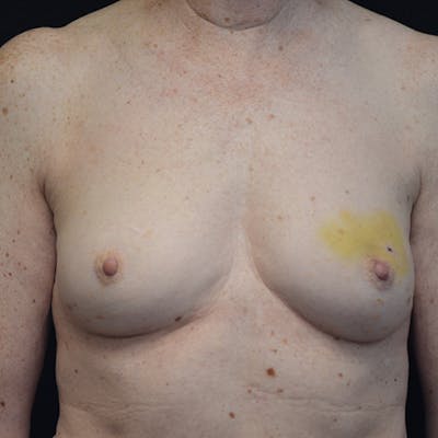 Breast Reconstruction Before & After Gallery - Patient 114721074 - Image 1