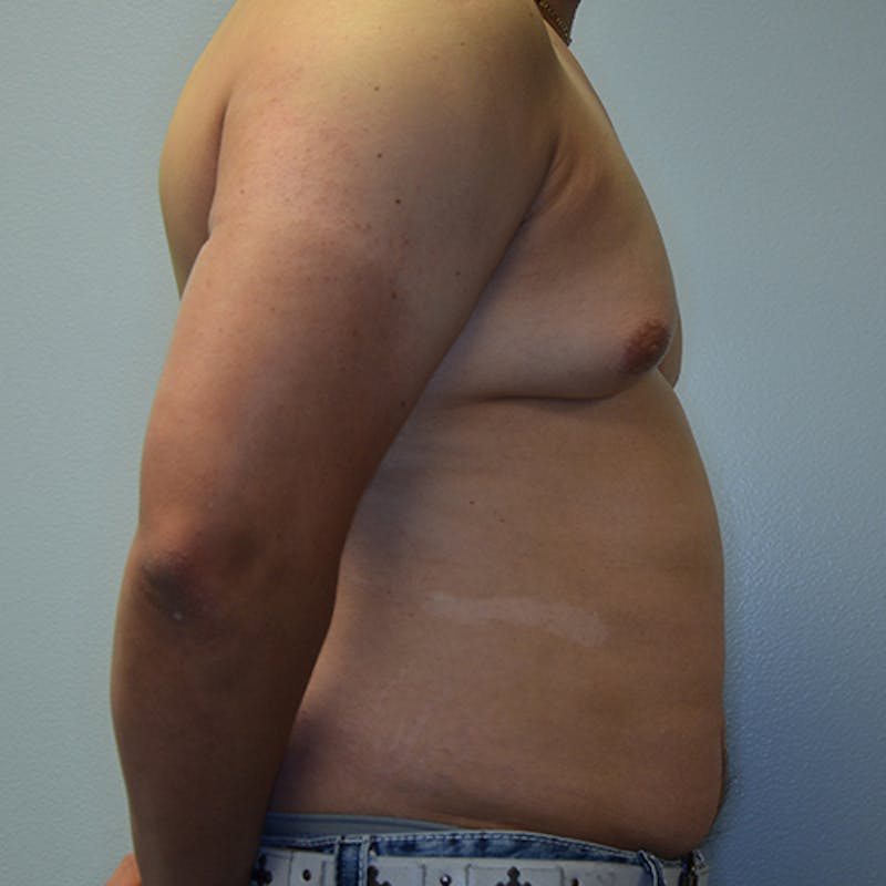 Gynecomastia Before & After Gallery - Patient 114721070 - Image 5
