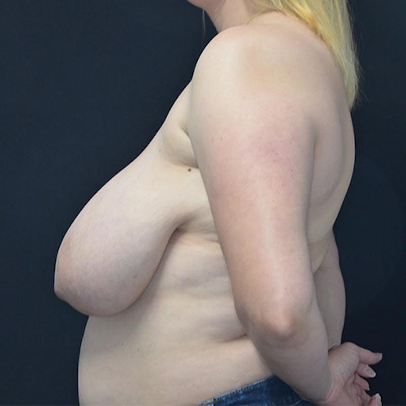 Breast Reduction Before & After Gallery - Patient 114721069 - Image 5