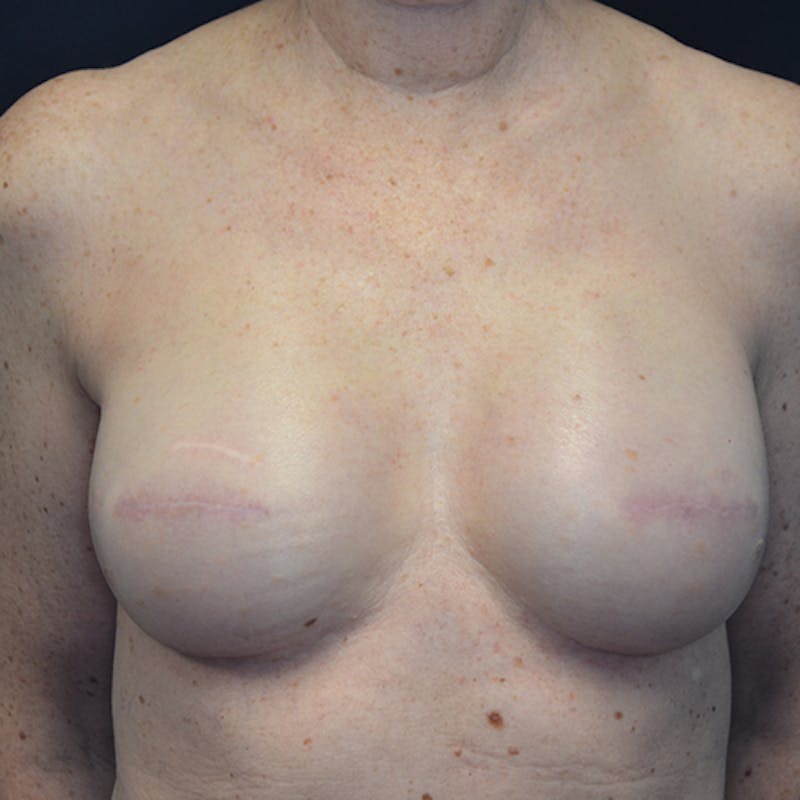 Breast Reconstruction Before & After Gallery - Patient 114721074 - Image 2