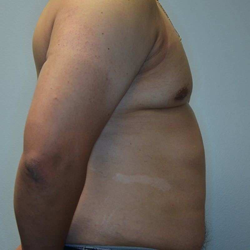 Gynecomastia Before & After Gallery - Patient 114721070 - Image 6