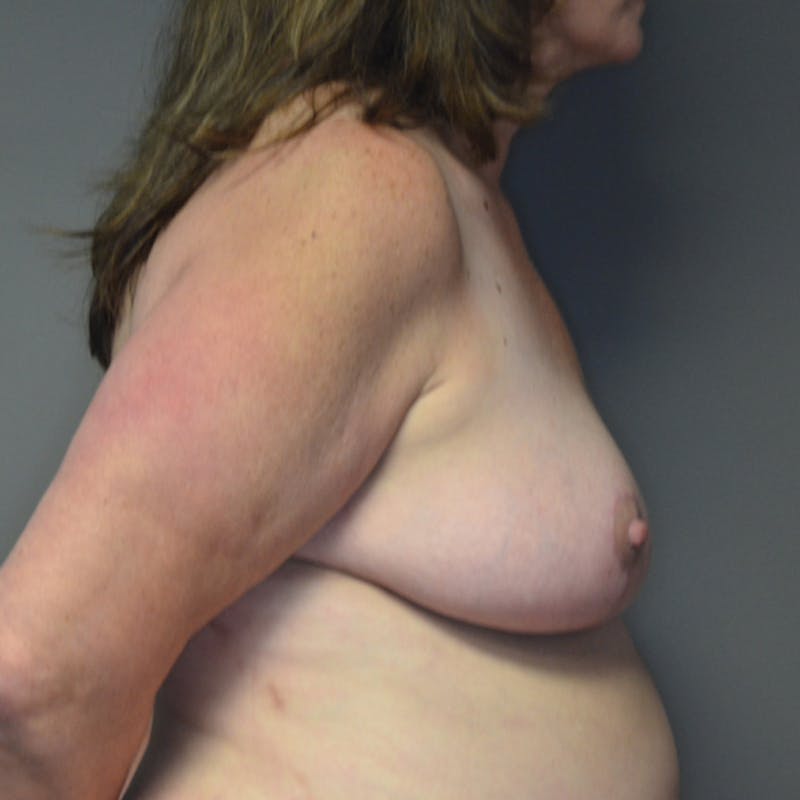 Breast Lift Before & After Gallery - Patient 114721071 - Image 6
