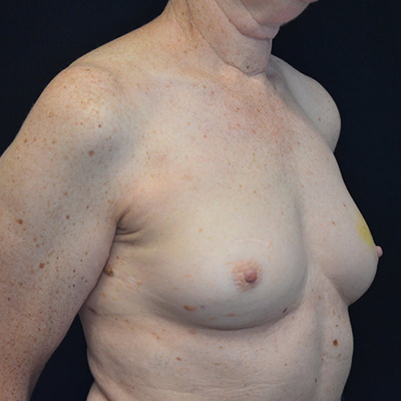 Breast Reconstruction Before & After Gallery - Patient 114721074 - Image 3