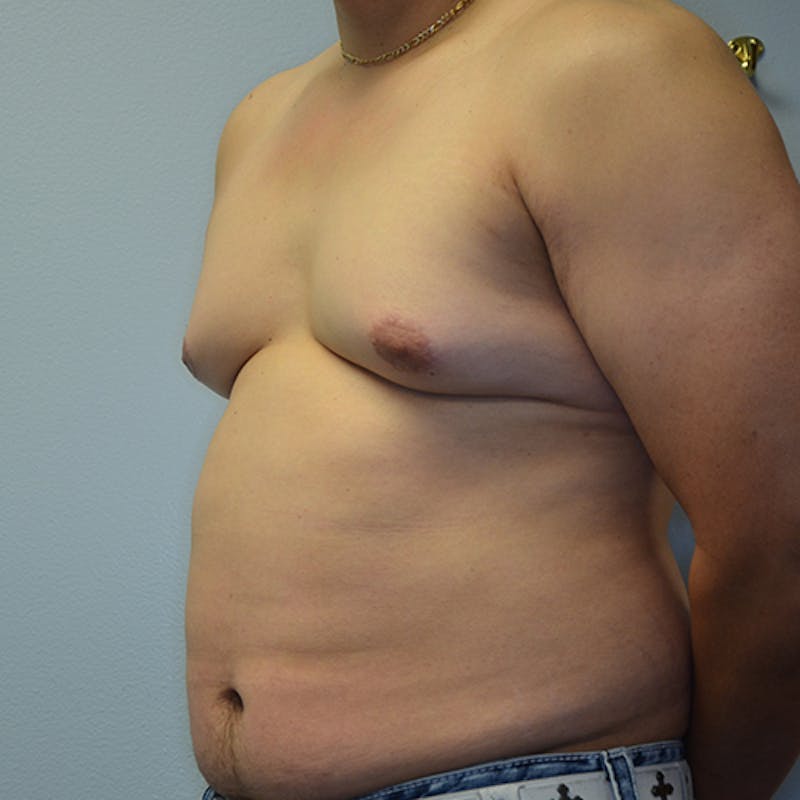 Gynecomastia Before & After Gallery - Patient 114721070 - Image 7