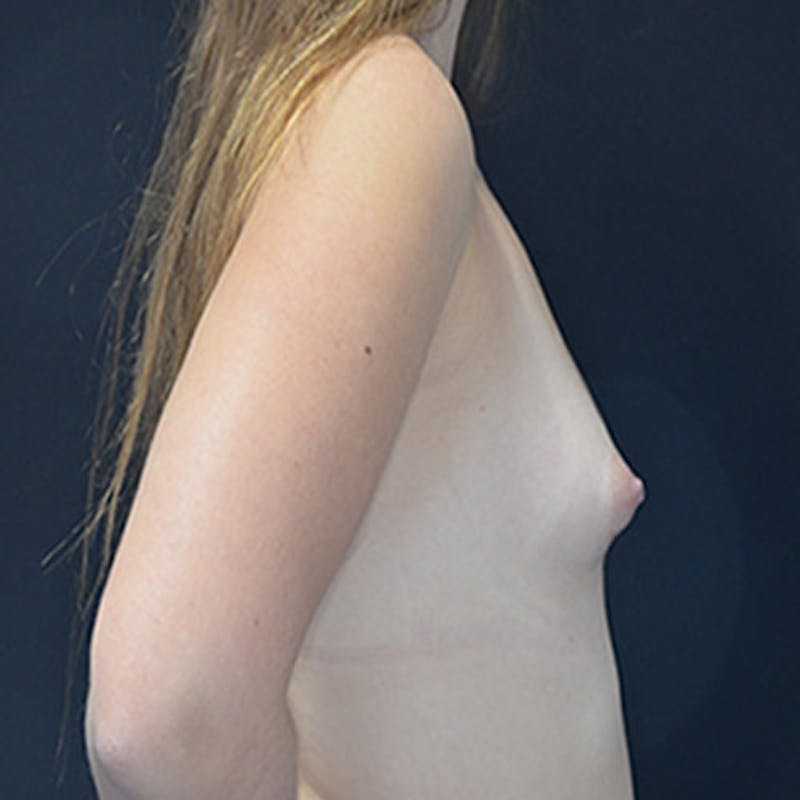 Breast Augmentation Before & After Gallery - Patient 114721072 - Image 5
