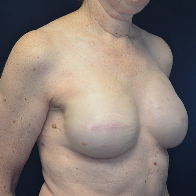 Breast Reconstruction Before & After Gallery - Patient 114721074 - Image 4