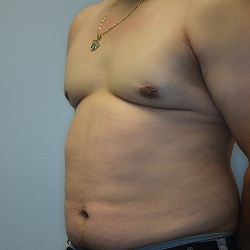 Gynecomastia Before & After Gallery - Patient 114721070 - Image 8