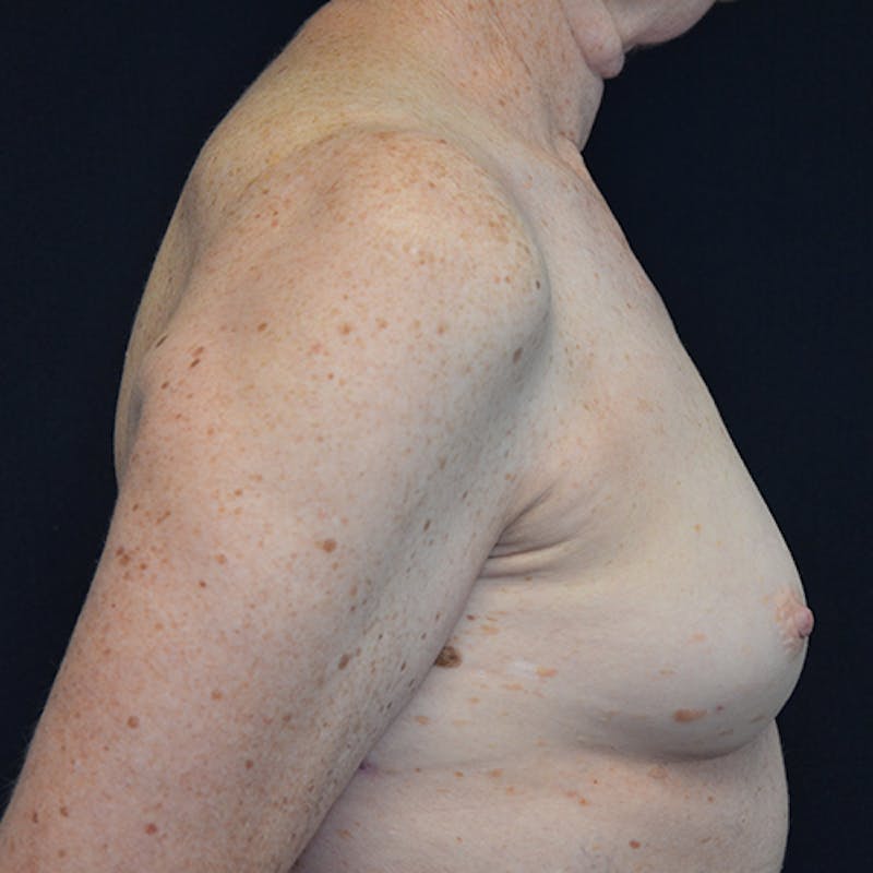 Breast Reconstruction Before & After Gallery - Patient 114721074 - Image 5
